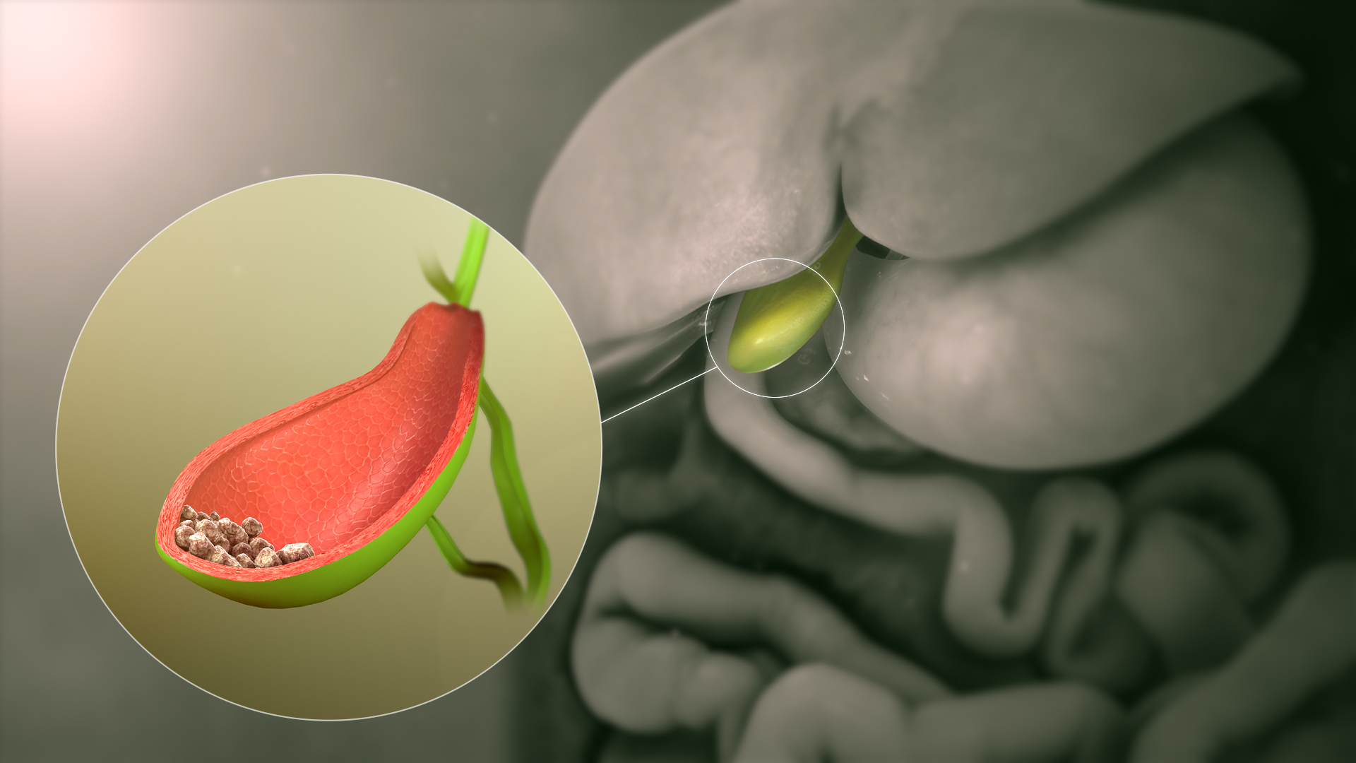 Gallstones Symptoms Causes Risks Treatment Diet and More